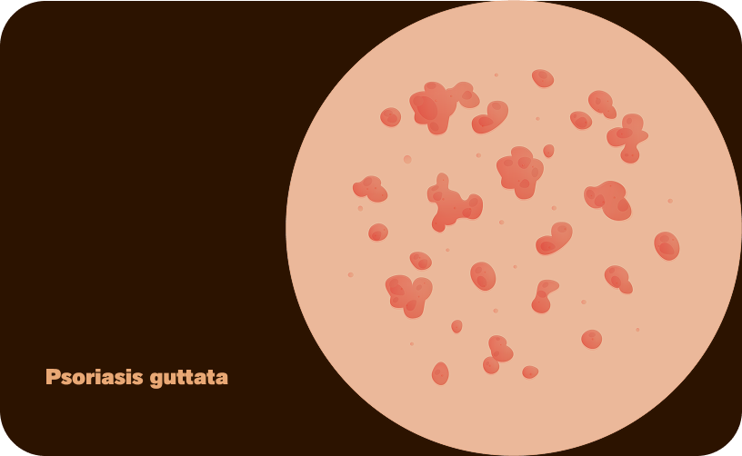 Guttate-DE-ohne Text